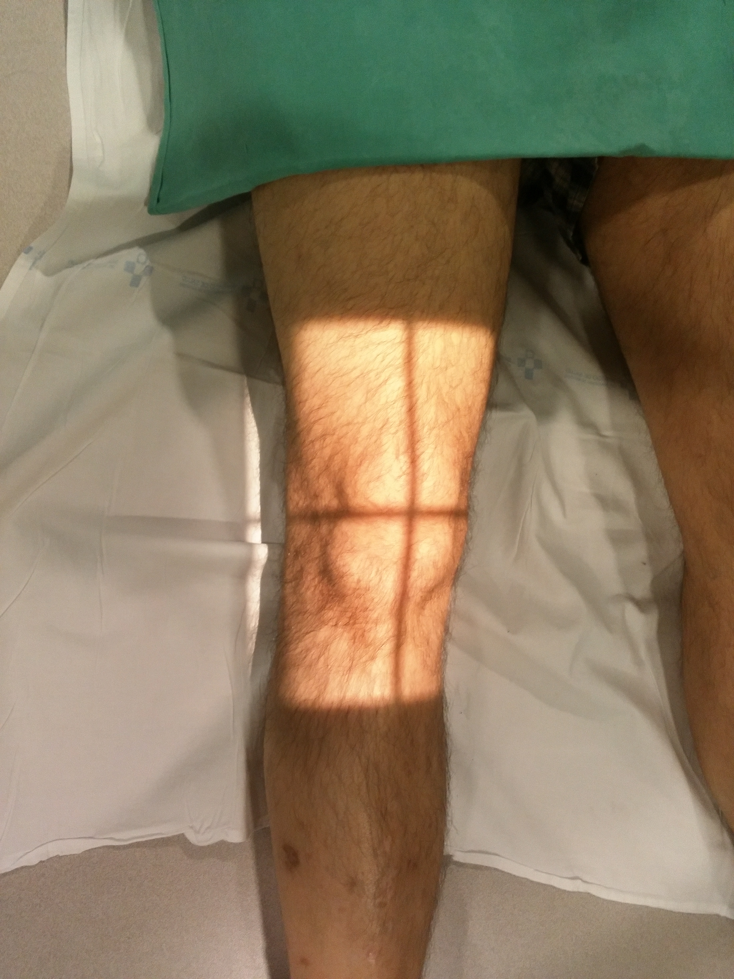 AP Knee Projection